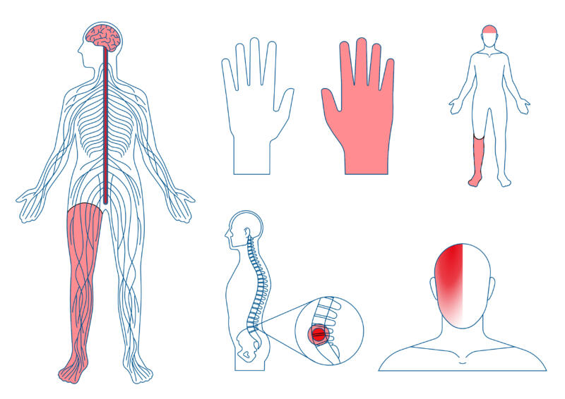 Illustrationer om neuropatisk smärta, CRPS, fantomsmärta, ryggsmärta, huvudvärk