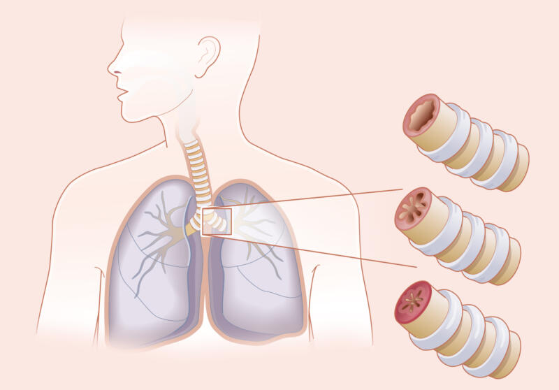 Genomskärning av en överkropp, där man zoomat i på luftstupen vid lungorna.