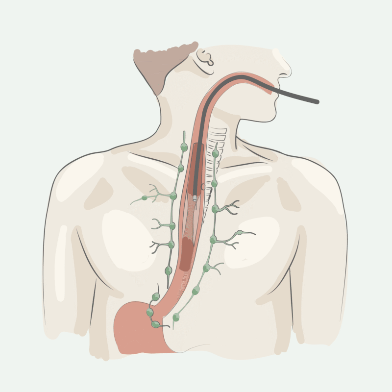 Medicinsk illustration på injektion av komponent i esofaguscancer