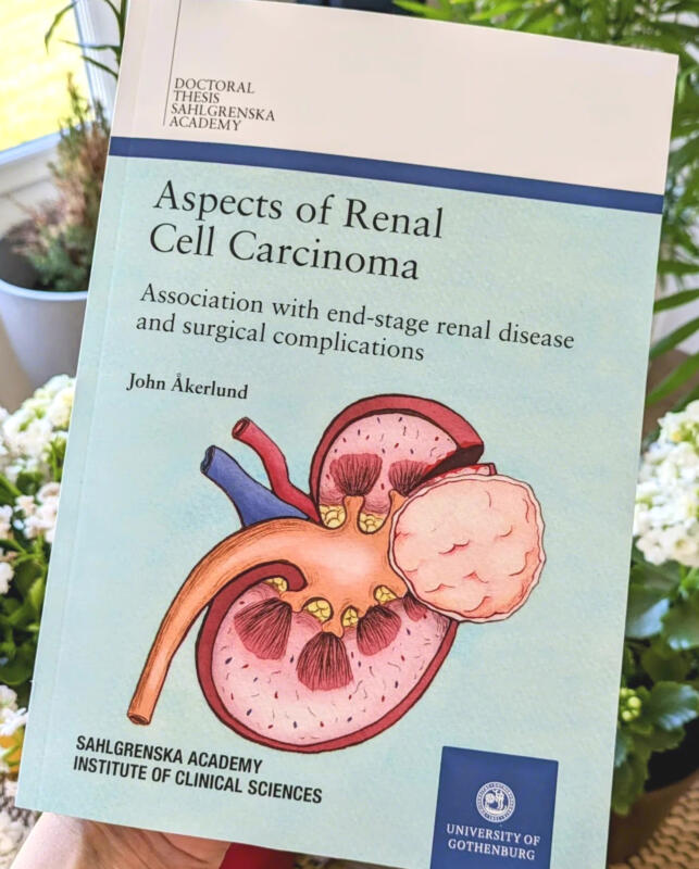 Fotografi av avhandlingen ”Aspects of Renal Cell Carcinoma” av John Åkerlund, med en illustration av en njure som innehåller en mindre tumör