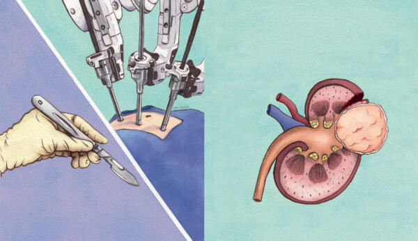 Illustration av kirurgi vid njurcancer med en handskbeklädd hand som håller en skalpell, en robotinstrument som opererar magen och en njure med en tumör