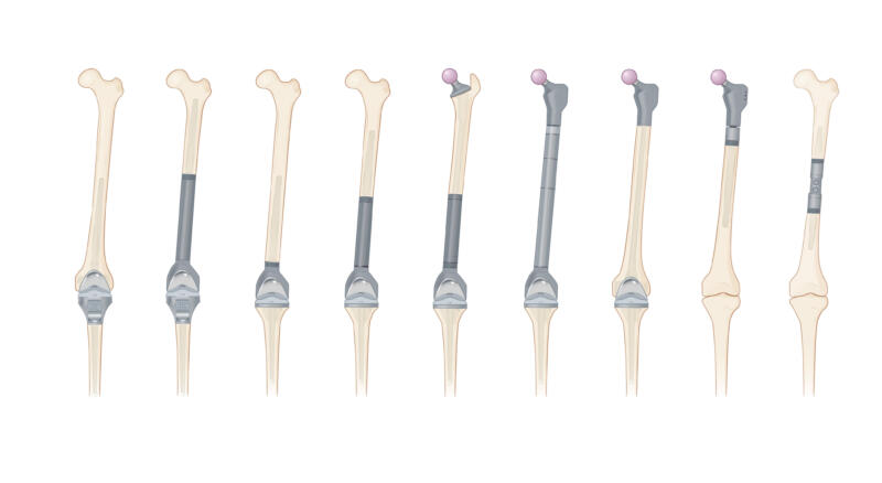 Illustration med nio lårben i rad, vart och ett visat med en annan typ av knäprotes, från en enklare ledyta till proteser som ersätter allt större delar av benet.